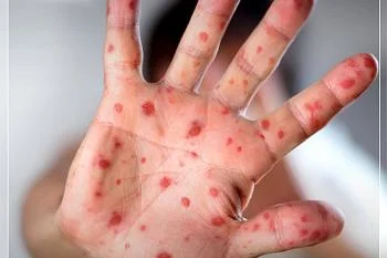 ⚡⚡⚡Корь - опасное острое инфекционное заболевание.